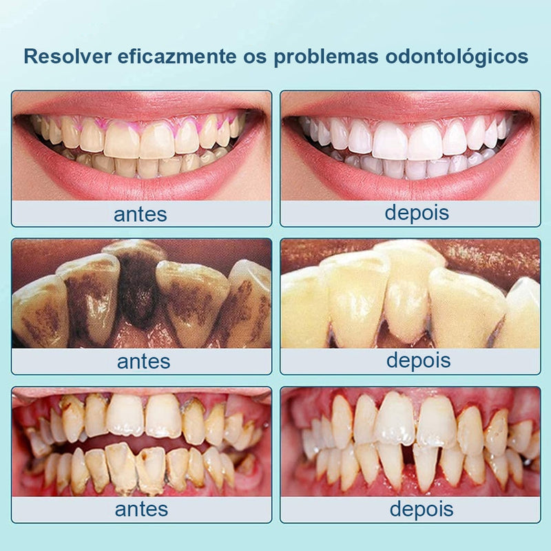 Removedor de tártaro e cálculos dentais ultrassônico elétrico para limpeza de placa bacteriana e remoção de pedra dental nos dentes